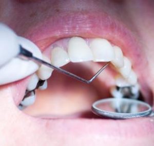 Mercury-Free Dentistry 