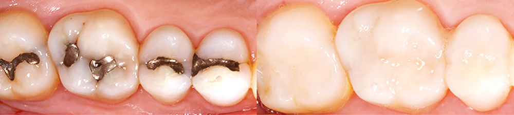 Mercury-Free Dentistry 